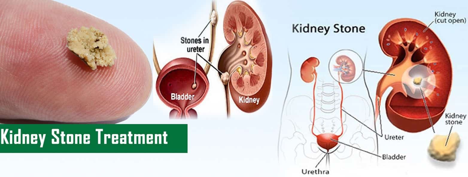 does zonegran cause kidney stones